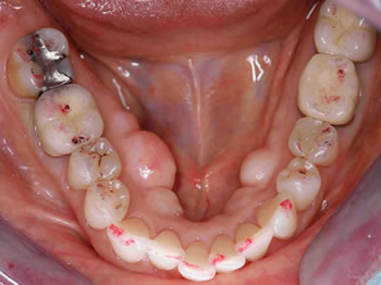 δυσλειτουργία κροταφογναθικής διάρθρωσης,εξισορρόπηση σύγκλεισης δοντιών,εκλεκτικός τροχισμός δοντιών